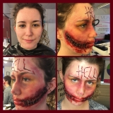 Chelsea smile before and after