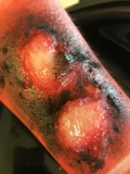Burnt skin with blistering