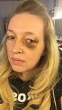 Bruised eye